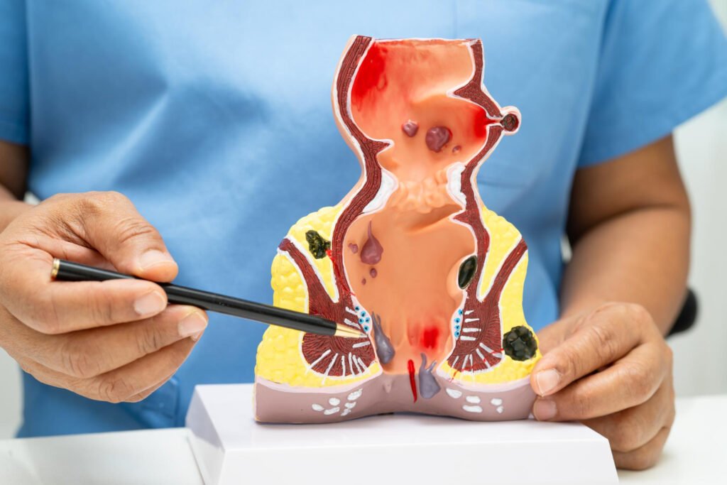 αιμορροΐδες