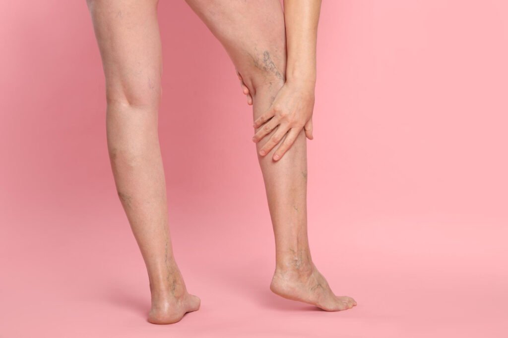 ευρυαγγείες