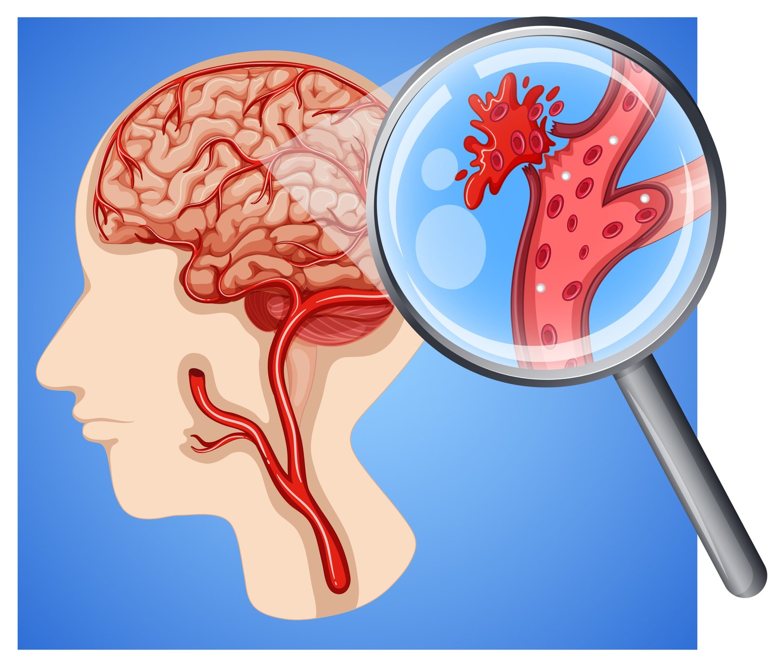 ανεύρυσμα-εγκεφάλου