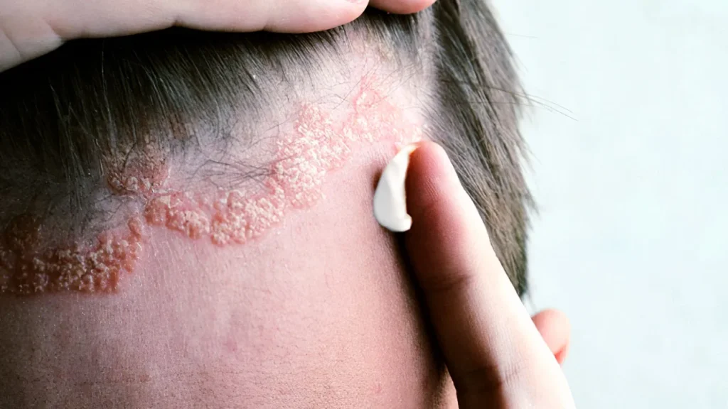 Σμηγματορροϊκή δερματίτιδα: συμπτώματα, αιτίες και θεραπεία