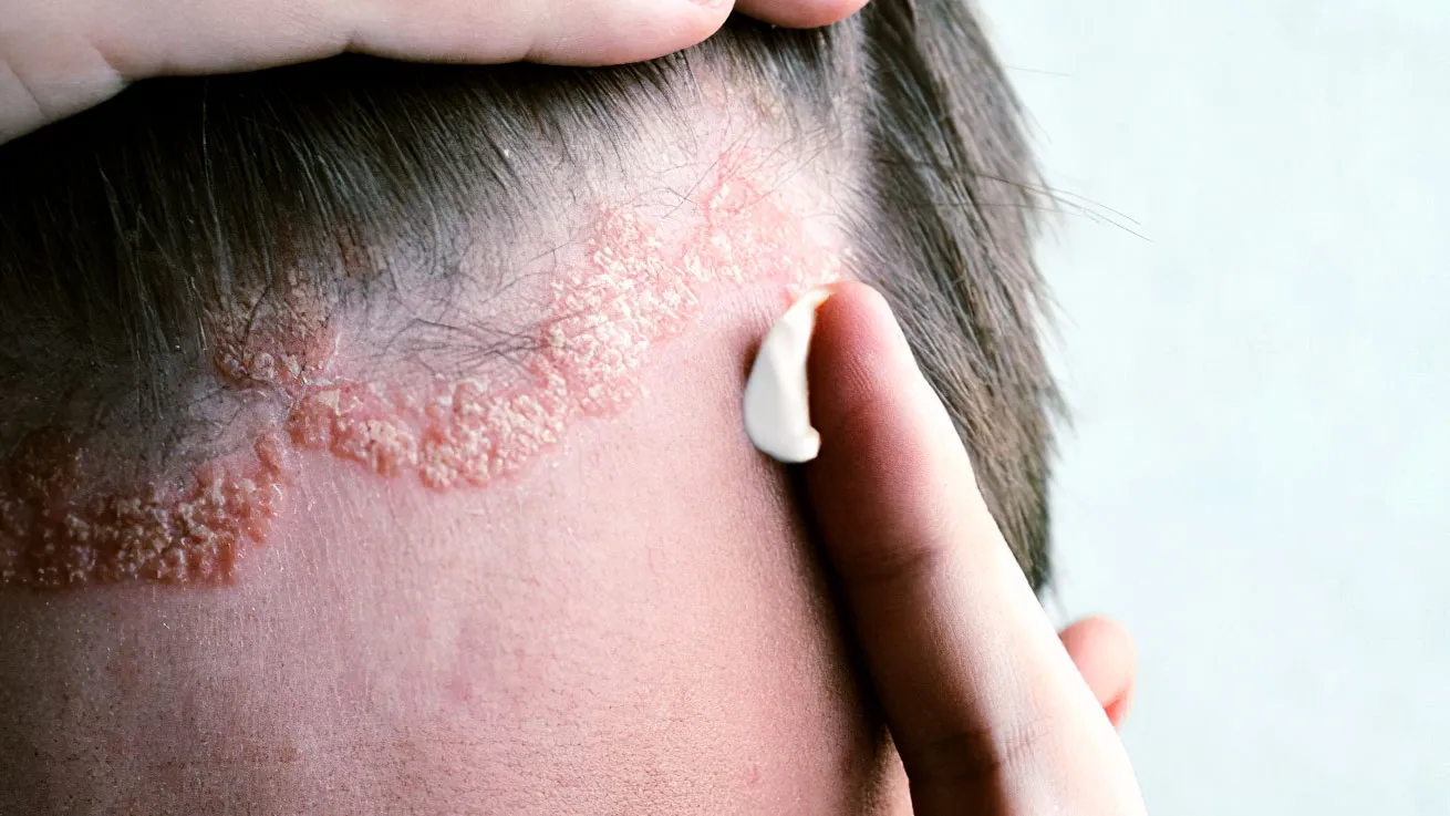 Σμηγματορροϊκή δερματίτιδα: συμπτώματα, αιτίες και θεραπεία