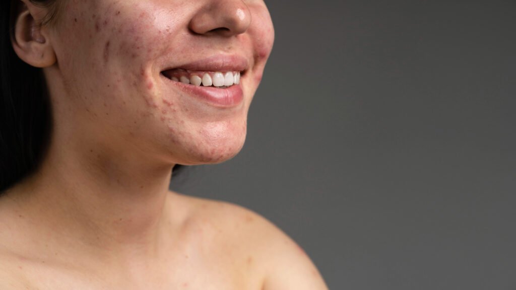 Ποιο-δερματολόγο-να -επιλέξω-για-την-ακμή;