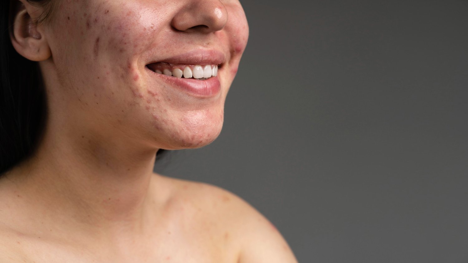 Ποιο-δερματολόγο-να -επιλέξω-για-την-ακμή;