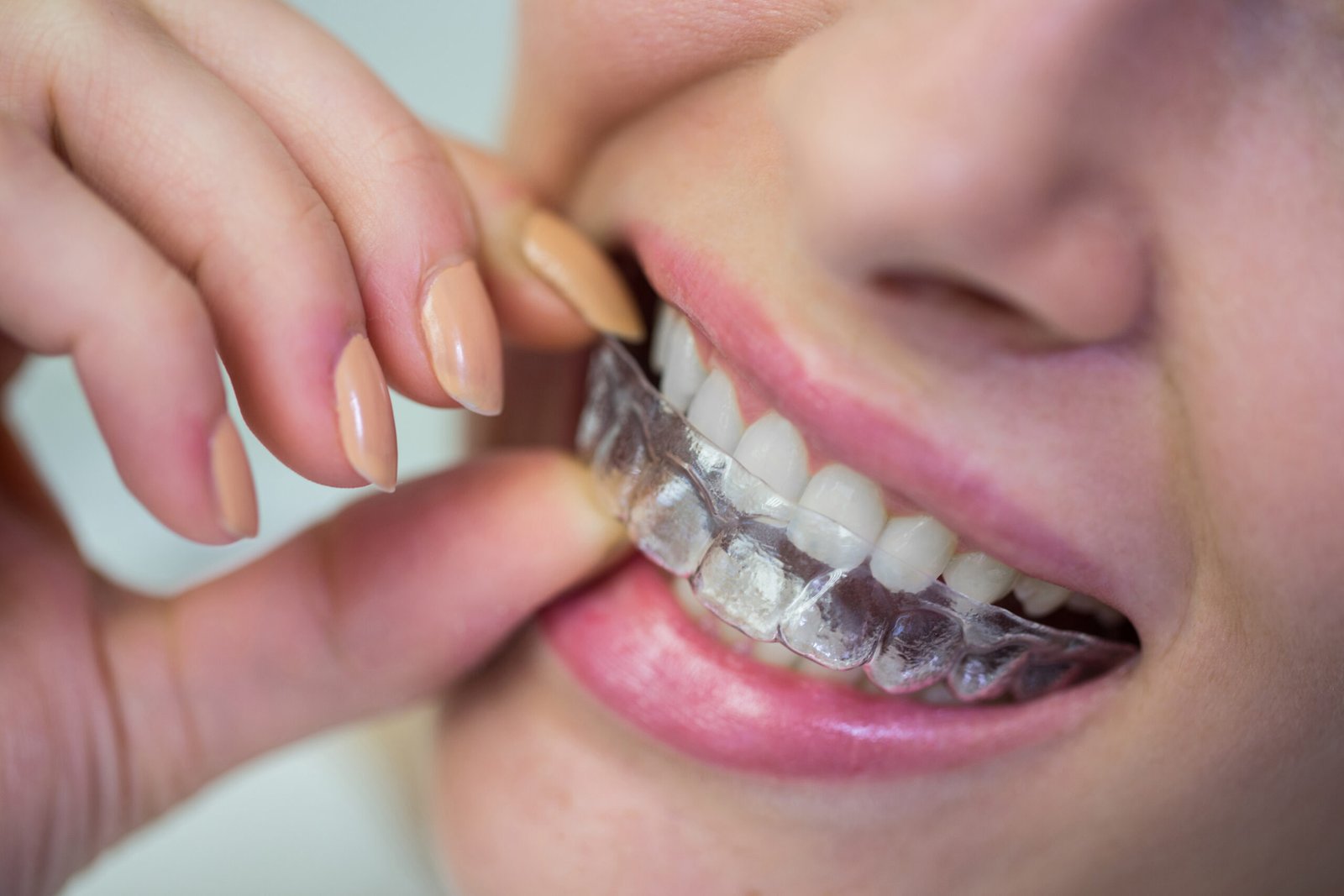 Invisalign για εφήβους ή ενήλικες; Υπάρχουν διαφορές;