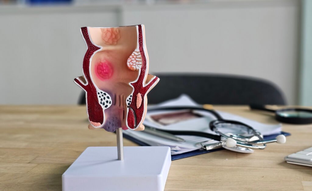 anal fissure treatment